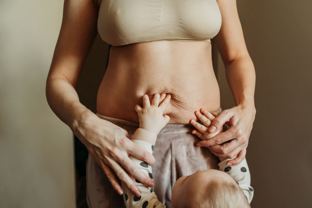 Can Exercise Help With Diastasis Recti? - Hero image